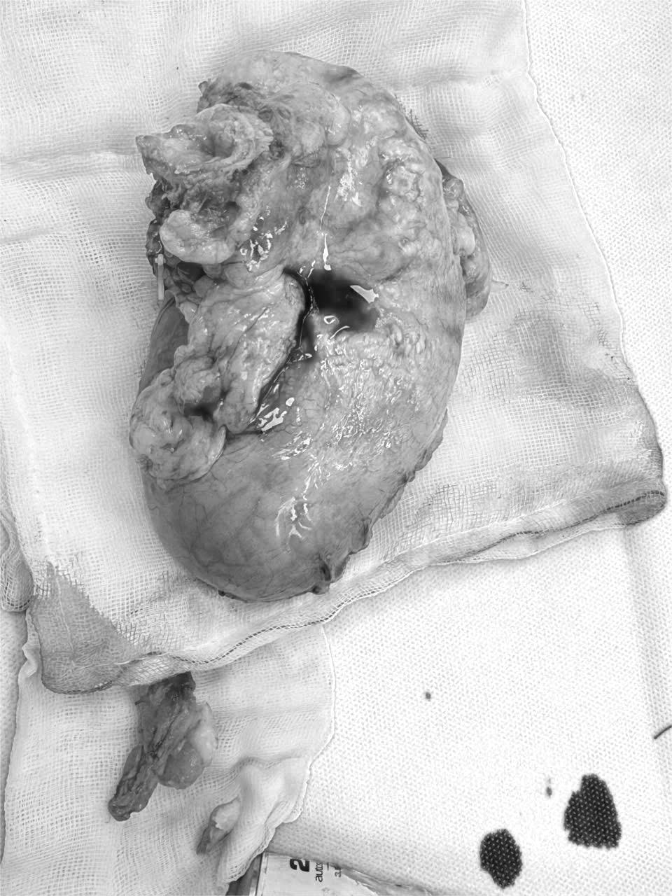 Đây là khối u có kích thước 10cm đã được phẫu thuật từ bệnh nhân