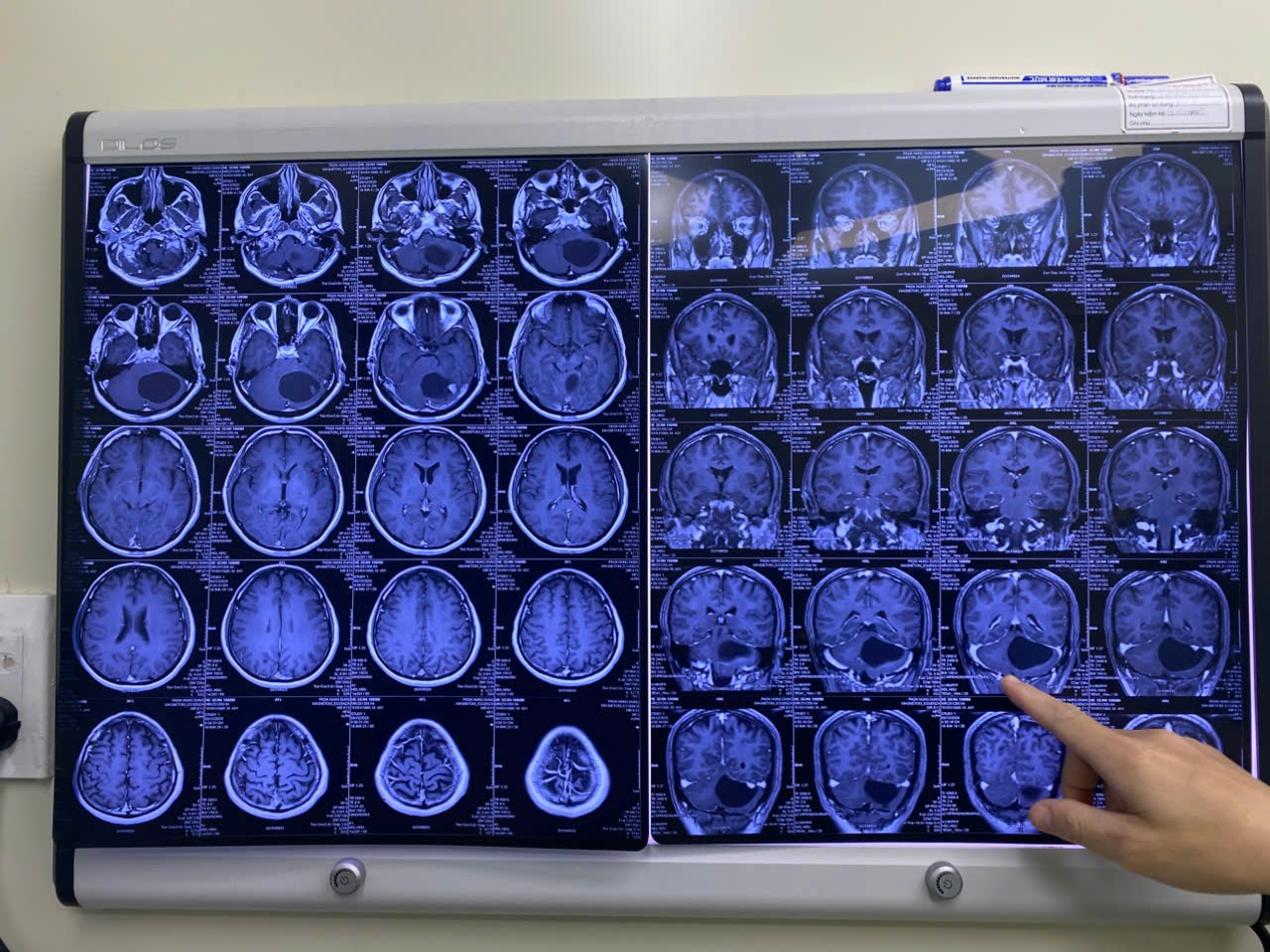 Kết quả chụp CT-Scanner của bệnh nhân được chụp tại Bệnh viện Đa khoa Quốc tế Minh Anh