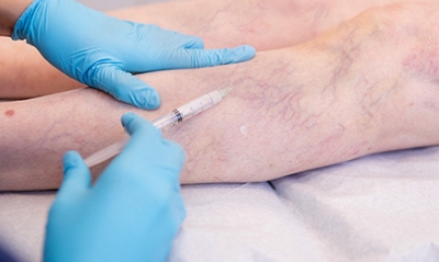Chích xơ tĩnh mạch, phương pháp điều trị giãn tĩnh mạch hiệu quả