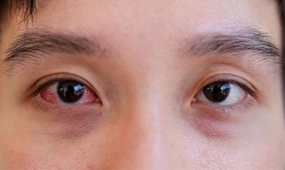 Đau mắt đỏ, làm gì để giảm bệnh?