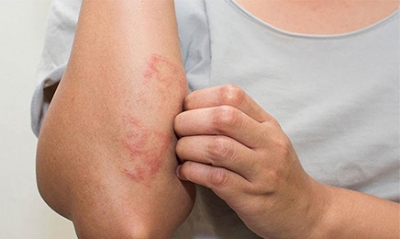 Viêm da cơ địa, ai dễ mắc và điều trị thế nào?