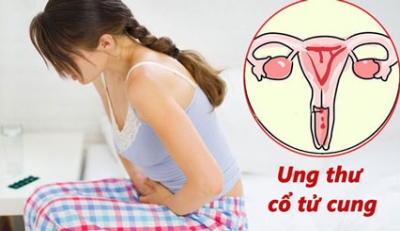 Chủ quan khiến phụ nữ  phải trả giá khi bị nhiễm virus HPV