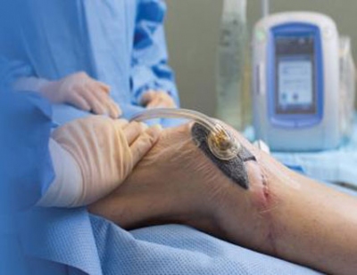 Sử dụng liệu pháp hút áp lực âm (VAC) điều trị vết loét, vết thương khó lành