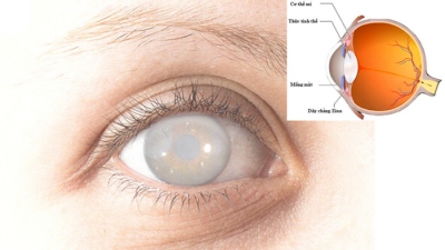 Đục thủy tinh thể - bệnh lý gây mù lớn nhất thế giới hiện nay
