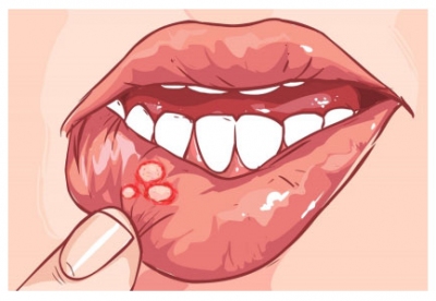 Bệnh loét miệng điều trị thế nào?