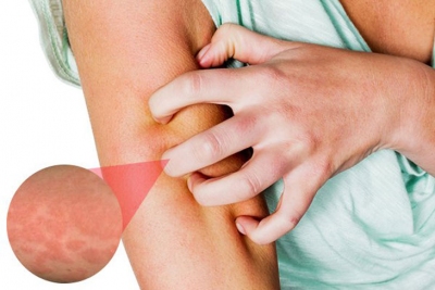 60586a4dd0975963ecdeae35 Ngứa da vào mùa đông lạnh 1