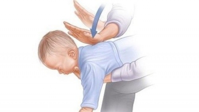 Bác sĩ tư vấn cách sơ cứu ngạt thở ở trẻ