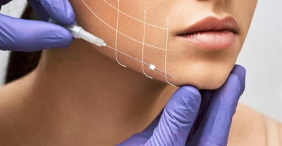 Cấy chỉ căng da mặt, giúp chị em rạng ngời, trẻ hơn tuổi thực