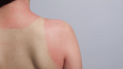 Sạm da mùa nắng nóng và cách khắc phục