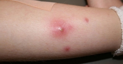 Mụn nhọt mùa nắng nóng