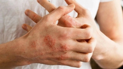 Bệnh dị ứng và eczema có liên quan gì tới nhau?