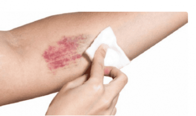 Những câu hỏi cần biết về bệnh lý giảm tiểu cầu miễn dịch