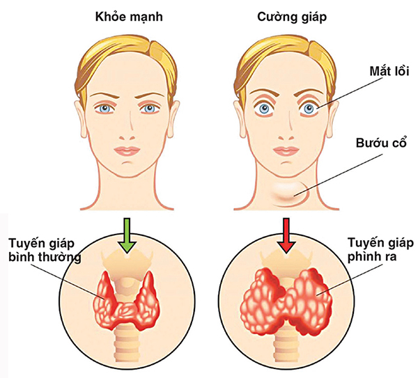 Lồi mắt trong bệnh bướu cổ cường giáp