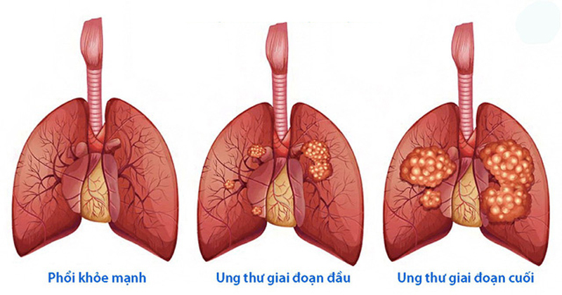 Tầm quan trọng của tầm soát ung thư phổi