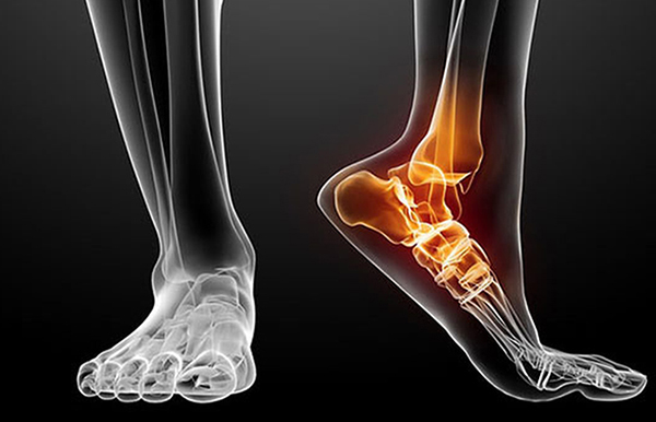H 3 Chấn thương là một yếu tố tác động làm thoái hóa khớp cổ chân