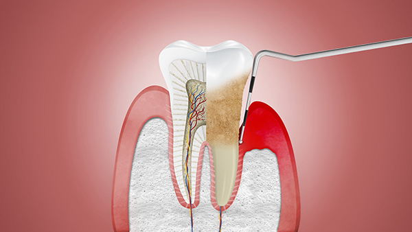 H4 Cao răng hay còn gọi là vôi răng