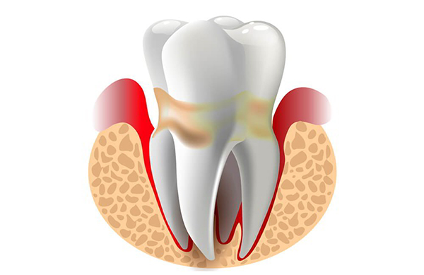 H5 Viêm nha chu gây lỏng lẻo chân răng, gây mất răng