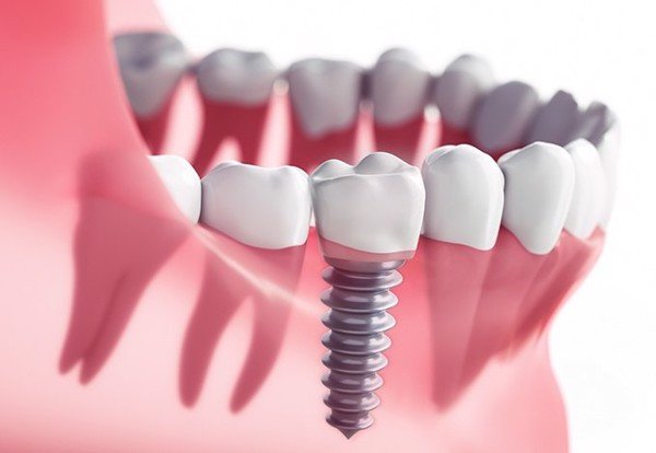 affordable dental implant mesa 42da1c4c348a4a19ad4062f866f3b689 grande