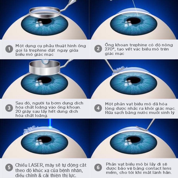 lasik(1)