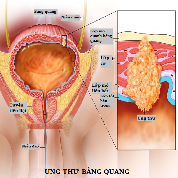 ung thu bang quang