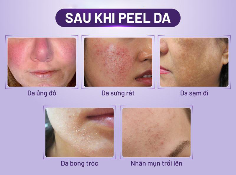 sau khi peel da nen lam gi