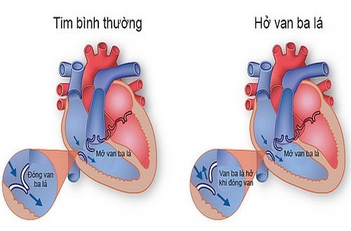 ho van 3 la la gi 1
