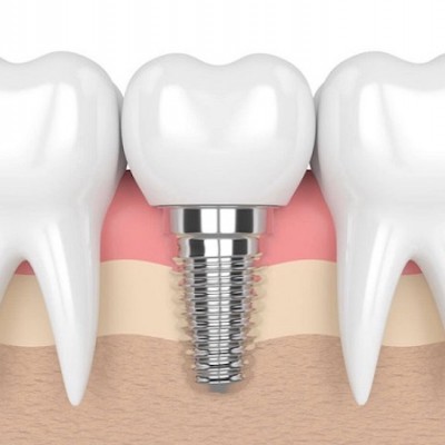 Phục hình răng ( Phần 1 )