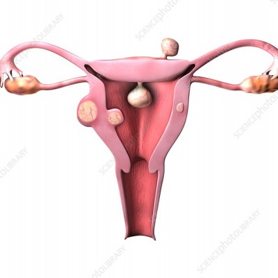 Sức khỏe sinh sản: U xơ tử cung ( Phần 4 )