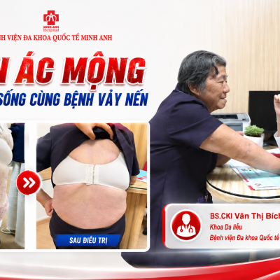 🔴 CƠN ÁC MỘNG 10 NĂM SỐNG CÙNG BỆNH VẢY NẾN